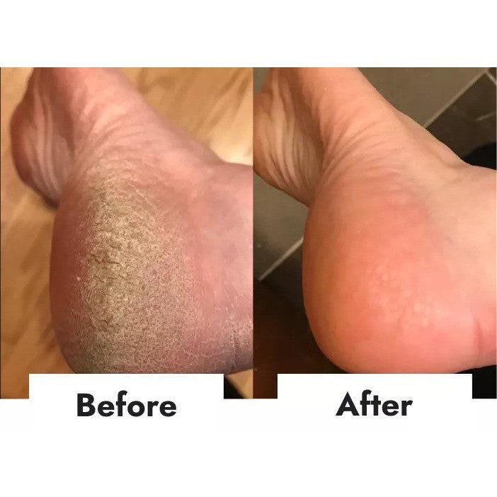 Pumice Stone, Foot Scrubber, Hard Skin Callus Remover, Pedicure Lava Exfoliator.